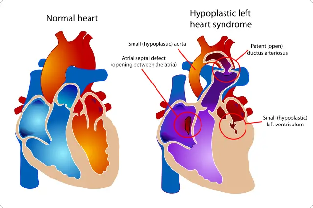 640px-Hypoplastic_left_heart_syndrome.svg
