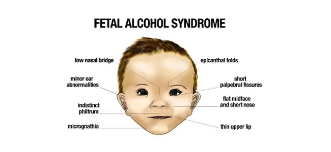 What is fetal alcohol syndrome fas)?   verywell