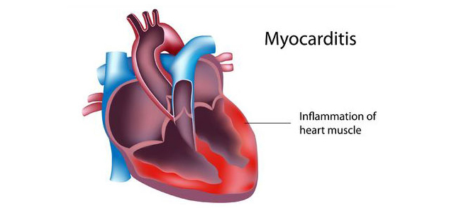myocarditis - photo #24