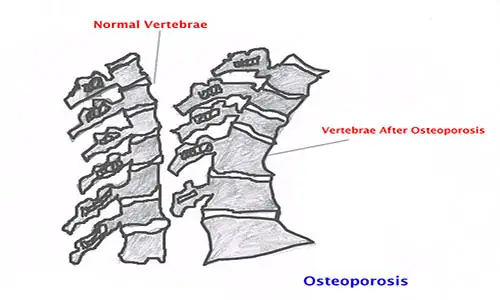 781px-Osteoporosis_vertebrae