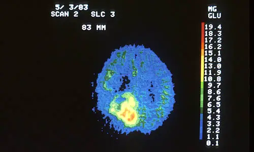 800px-Pet_scan_of_brain_tumor