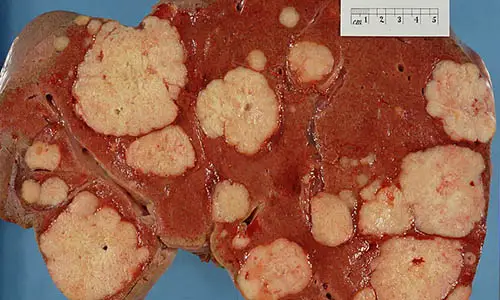 800px-Secondary_tumor_deposits_in_the_liver_from_a_primary_cancer_of_the_pancreas